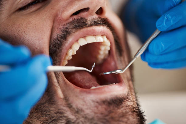 Best Emergency Dentist for Lost Fillings or Crowns in Tylertown, MS